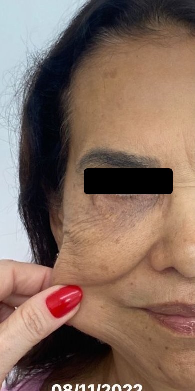 Antes: firmeza e qualidade da pele