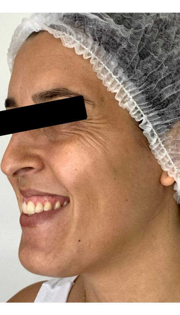 Antes: rejuvenescimento facial