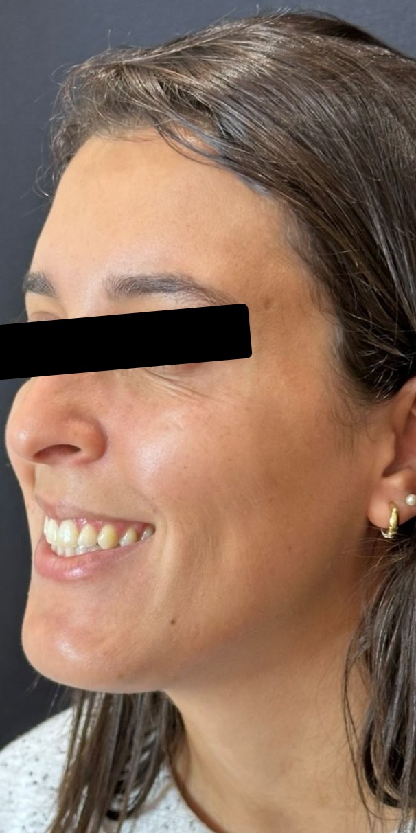 Depois: rejuvenescimento facial