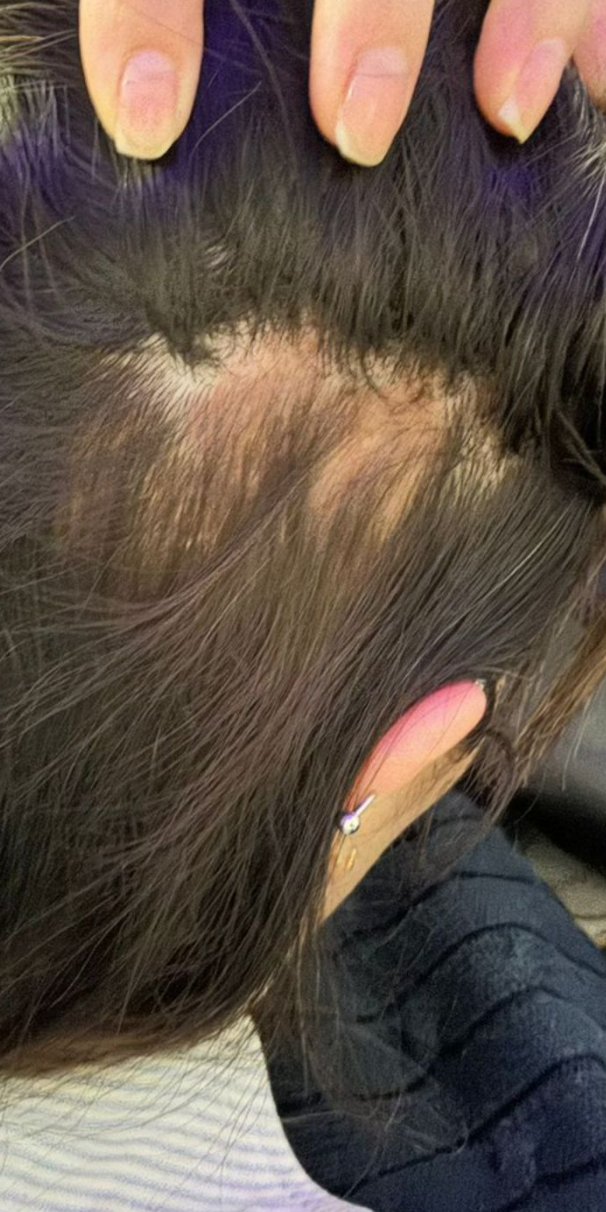 Antes: tratamento de alopecia