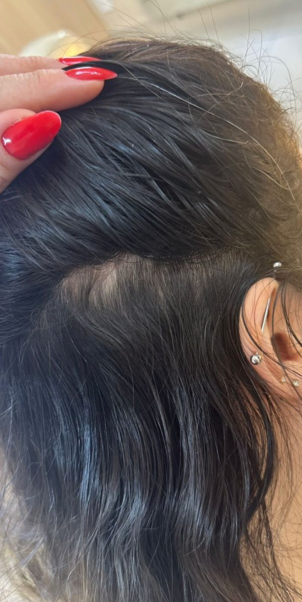Depois: tratamento de alopecia
